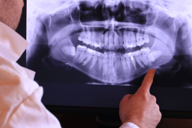 Best Emergency Tooth Extraction in Sandy, UT