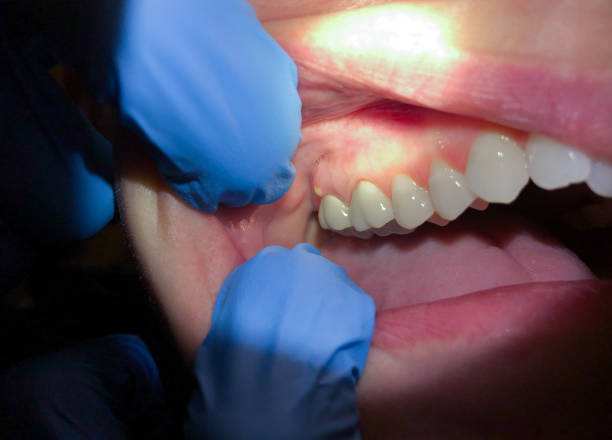Best Emergency Denture Repair in Sandy, UT